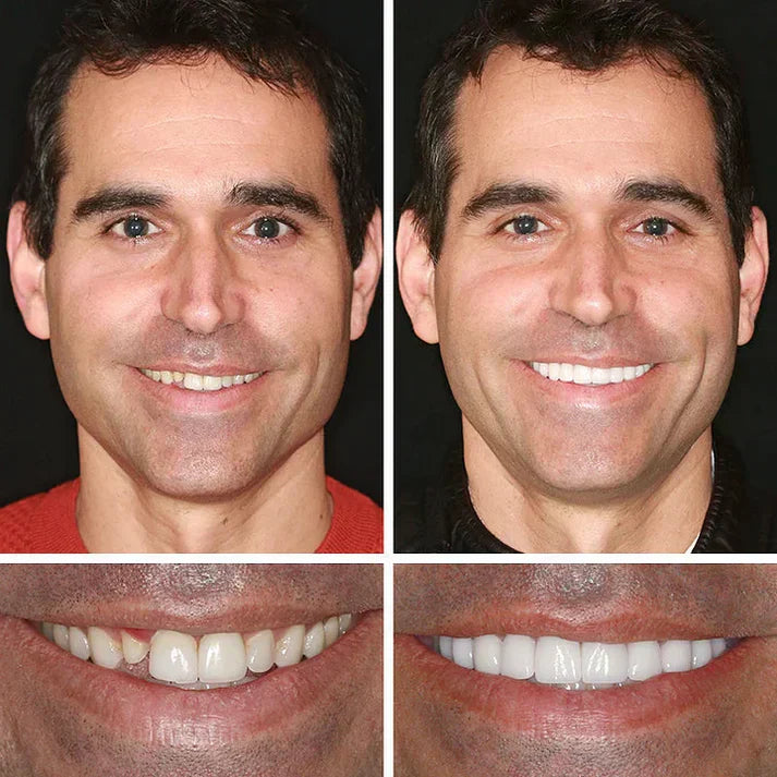 🏆Ends Today: 70% OFF!  🏆2026 Bestselling Product🦷 Fit for a Fresh Smile, Say Goodbye to Wearing Discomfort!🌎