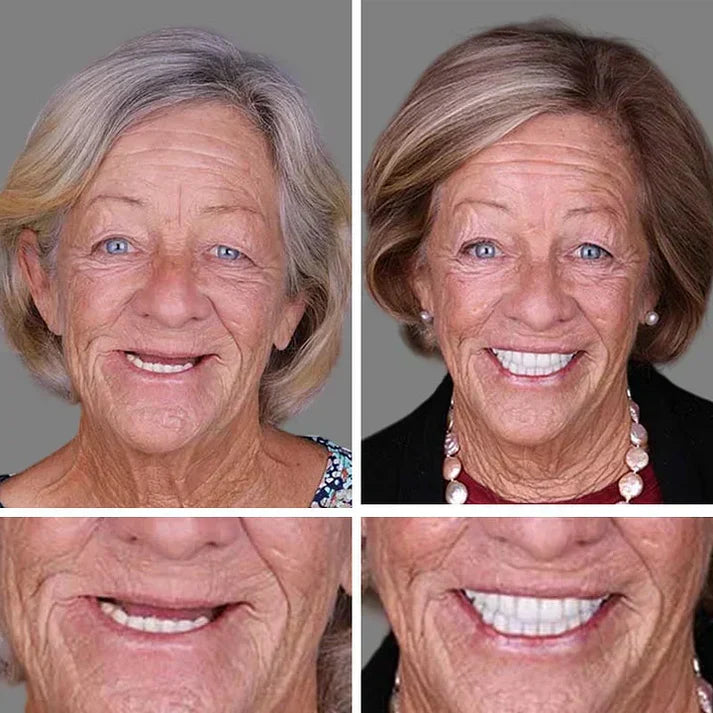 🏆Ends Today: 70% OFF!  🏆2026 Bestselling Product🦷 Fit for a Fresh Smile, Say Goodbye to Wearing Discomfort!🌎
