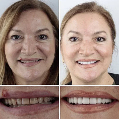 🏆Ends Today: 70% OFF!  🏆2026 Bestselling Product🦷 Fit for a Fresh Smile, Say Goodbye to Wearing Discomfort!🌎