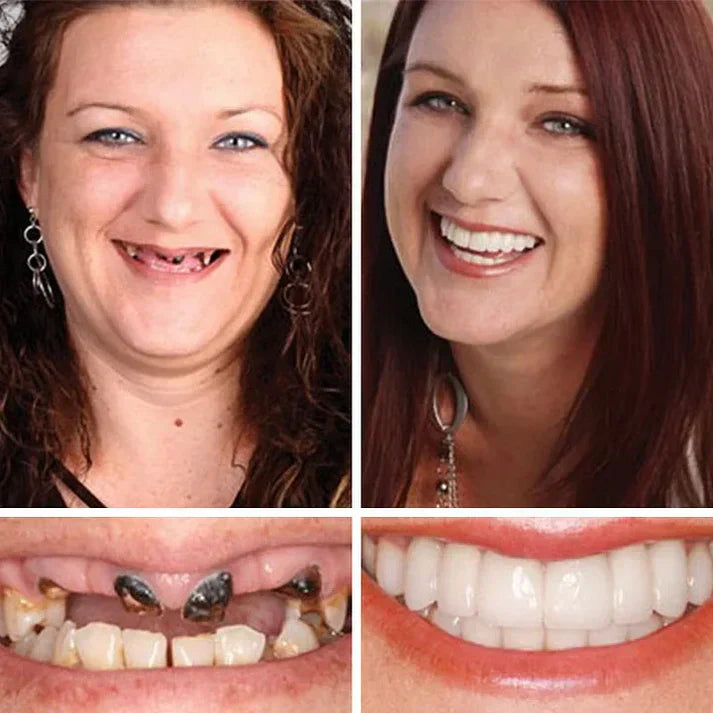 🏆Ends Today: 70% OFF!  🏆2026 Bestselling Product🦷 Fit for a Fresh Smile, Say Goodbye to Wearing Discomfort!🌎