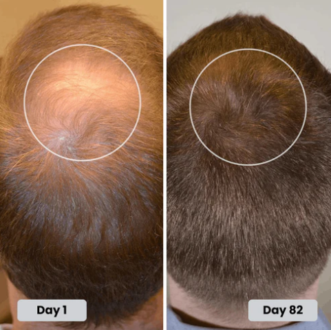 🔥HOT SALE 49% OFF🔥Red light hair growth CAP — Regrow Thicker Hair in 90 Days