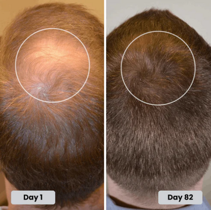 🔥HOT SALE 49% OFF🔥Red light hair growth CAP — Regrow Thicker Hair in 90 Days