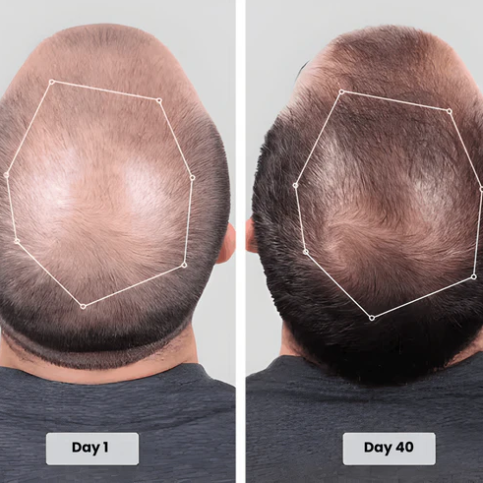 🔥HOT SALE 49% OFF🔥Red light hair growth CAP — Regrow Thicker Hair in 90 Days