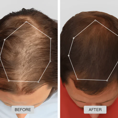 🔥HOT SALE 49% OFF🔥Red light hair growth CAP — Regrow Thicker Hair in 90 Days