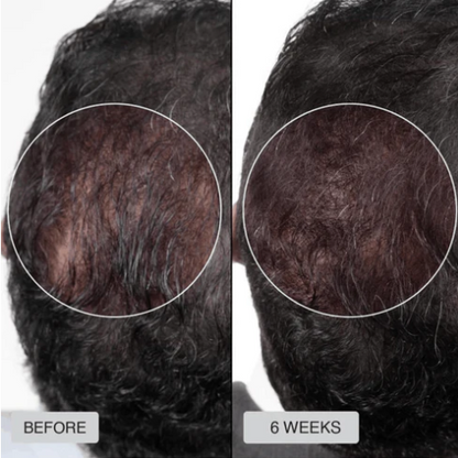 🔥HOT SALE 49% OFF🔥Red light hair growth CAP — Regrow Thicker Hair in 90 Days