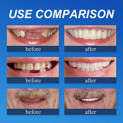 🏆Ends Today: 70% OFF!  🏆2026 Bestselling Product🦷 Fit for a Fresh Smile, Say Goodbye to Wearing Discomfort!🌎
